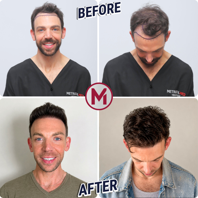 Before After 1