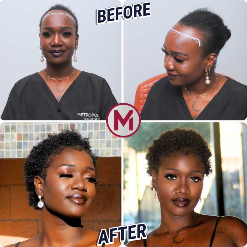 Before After 2