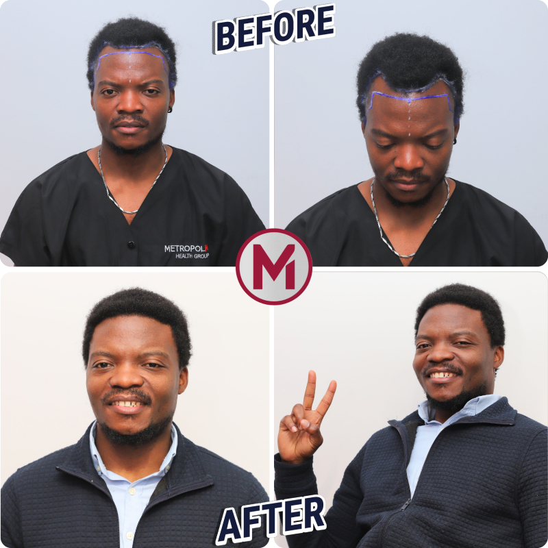 Before After 3