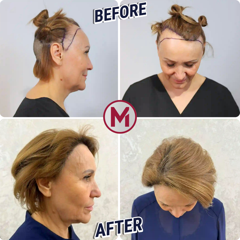 Before After 4