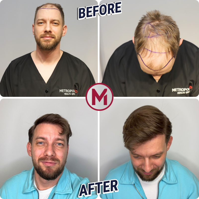Before After 5