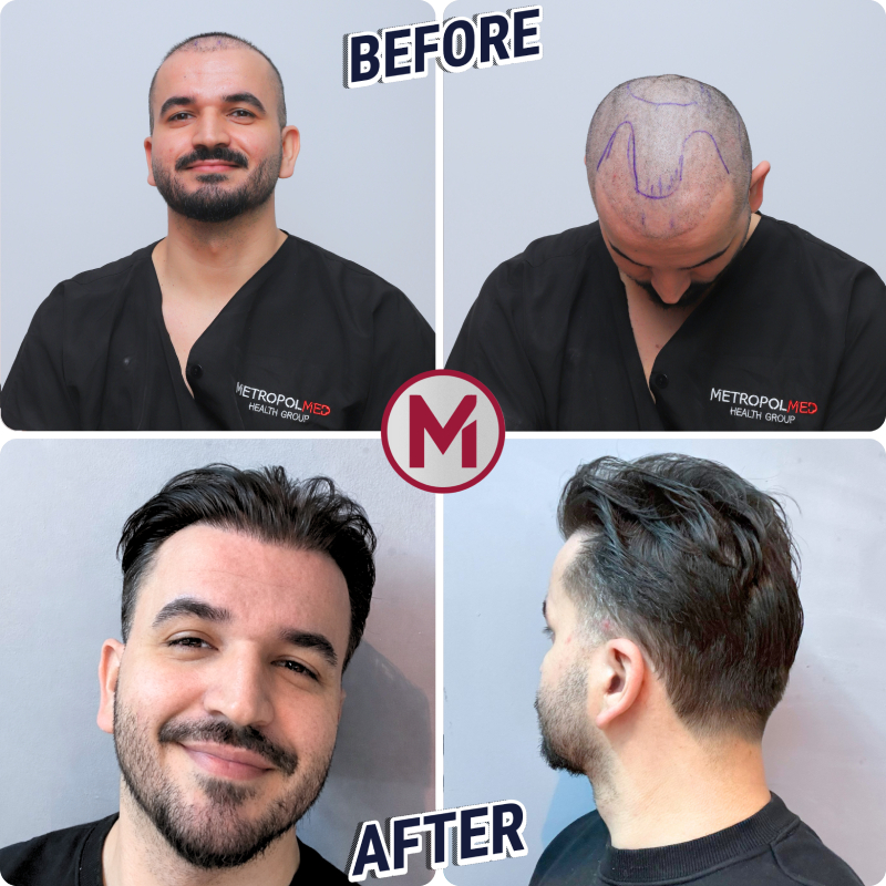 Before After 6